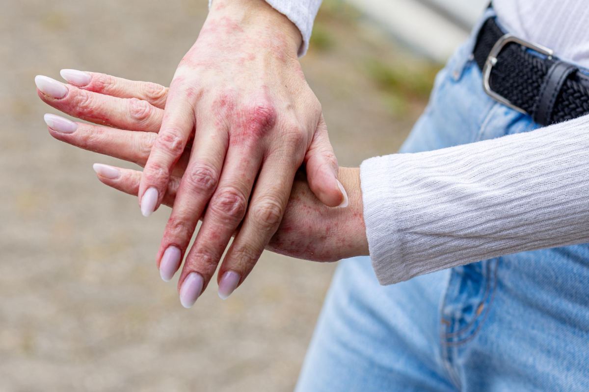 Aproape 400.000 de români trăiesc cu psoriazis. Boala poate afecta articulațiile și sănătatea mintală